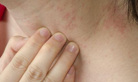 预防皮肤过敏有哪些方法？